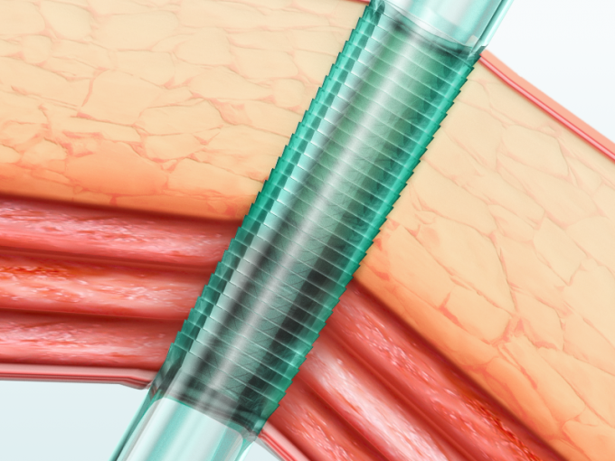Cannula Trocar Laparoscopic аппаратур устранимый с лезвием 0