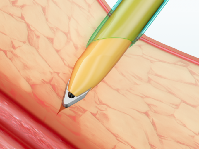 Cannula Trocar Laparoscopic аппаратур устранимый с лезвием 1